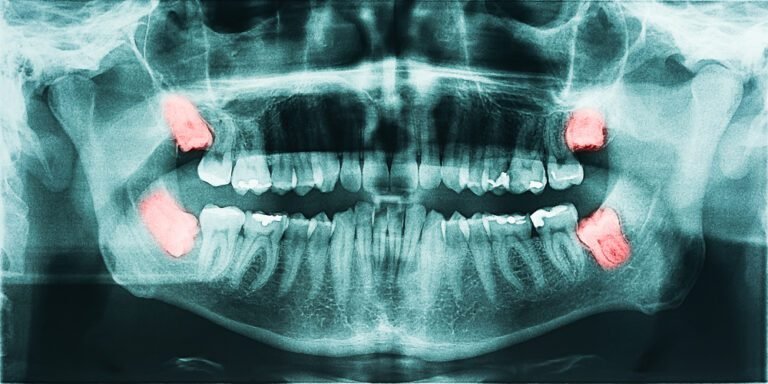 impacted wisdom teeth