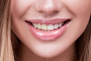Teeth Whitening Cost