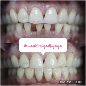 Tooth Crown Before and After