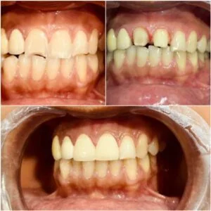 Tooth Crown Before and After