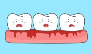 Periodontitis Gum Disease