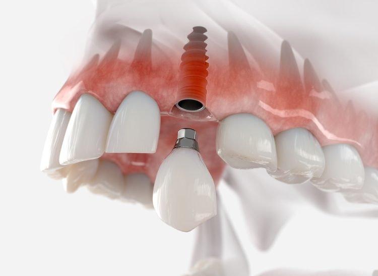 Dental Implant in Noida