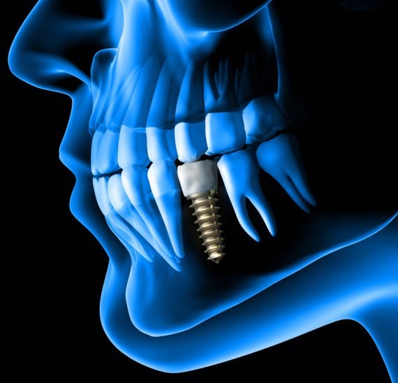 Dental Implant in Noida
